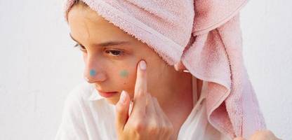 hautarzt über akne: »die wichtigste frage ist, ob und wie sehr das kind leidet«