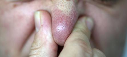 warum stinkt es in brendola so arg?