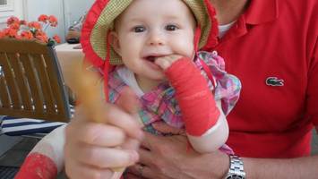 Als Baby schwer verbrüht – So geht es der tapferen Sehri heute