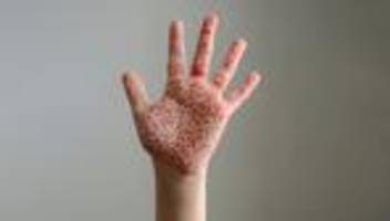 masern in Österreich: masernfrei