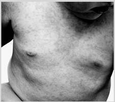 ideas: this is how a child dies of measles