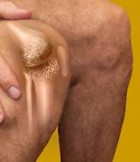 Unabhängig vom Gewichtsverlust: Wirkstoff in Abnehmspritzen könnte Arthrose lindern