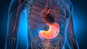 Arzt zu Symptomen bei Magenkrebs: „Bei Alarmzeichen ist es häufig schon zu spät“