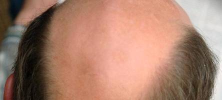 20 Glatzen für ein Ja-Wort: Mann macht seiner Zukünftigen in London kuriosen Heiratsantrag