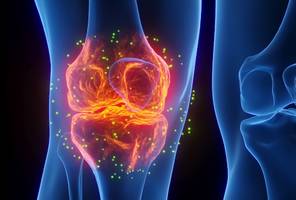 viele halten arthrose für unvermeidbar – ein irrtum