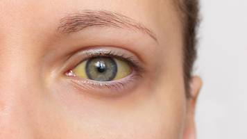 gelbsucht: symptome, ursachen und folgen