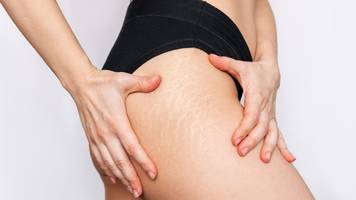 dehnungsstreifen: ursachen und wann sie zum arzt müssen