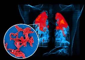 WHO: Hohe Dunkelziffer: Tuberkulose wird für Europa zunehmend zur tödlichen Gefahr