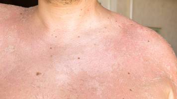 longevity beginnt bei der haut: so schützen sie sich richtig vor uv-schäden