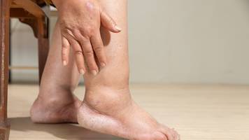 Ödem: Ursachen, Symptome und wann Sie zum Arzt müssen