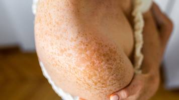 Pigmentflecken: Ursachen, Krankheiten und wann es ernst wird