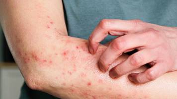 hautausschlag: ursachen, krankheiten und wann es gefährlich wird