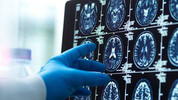 29 Krankheiten und Verletzungen erhöhen Ihr Demenzrisiko