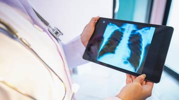 lungenkrebs-screening startet – wem es wirklich hilft