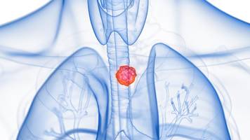 Speiseröhrenkrebs: Neue Studie zeigt, dass Tumoren überleben, wenn sie eine Nische haben