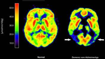 Alzheimer-Studie: Wirkung von neuartigen Medikamenten nur „trivial“