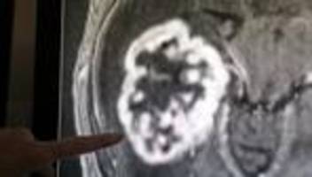 aktionsmonat april: krebsdaten: rückgang der neuerkrankungen bei männern