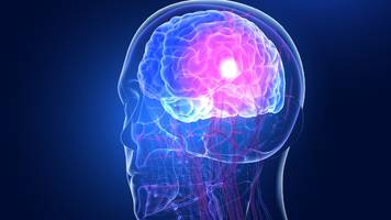 rund zwei millionen haben stille zeitbombe im kopf – wie sie vorbeugen