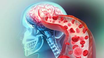 7 tage nach infekt befinden wir uns in schlaganfall-zone