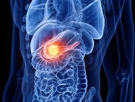 Bauchspeicheldrüsenkrebs: was deutsche mRNA-Impfung bei aggressivster Krebsart kann
