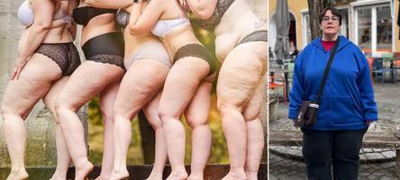 „Ich dachte, ich bin einfach nur dick und faul“: Sie will das Thema Lipödem aus der Tabuzone holen