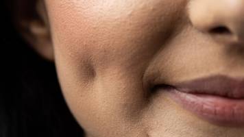 Grübchen gelten als Sympathie-Merkmal und sind heute planbar