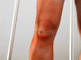 meniskus-operation am knie: verbreiteter chirurgischer eingriff könnte nutzlos - und sogar schädlich sein