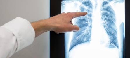 Tuberkulose in Lauingen: Was Sie jetzt wissen müssen
