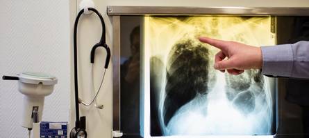 tuberkulose in lauingen: erkrankung bei kindern bestätigt
