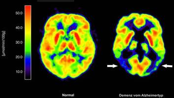 Überzuckerung im Gehirn: Neue Studie entlarvt Arthrose-Mittel als Demenz-Treiber