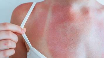 Strahlenschutz-Amt warnt vor Sonnenbrand-Gefahr – „extremer“ UV-Index möglich