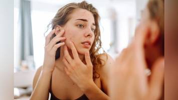 Akne & Sonnencreme: Auf diese 5 Punkte sollten Sie laut Dermatologin achten