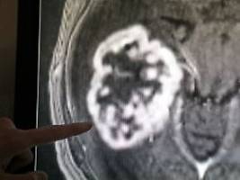 trotz fortschritts der medizin: who warnt vor drastischem anstieg von krebs