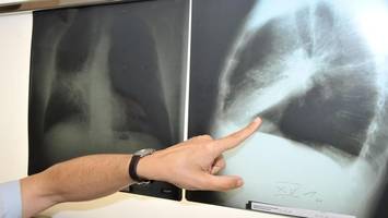 Lungenkrebs-Screening als Kassenleistung: So kommen Sie an einen Termin