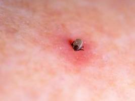 Richtig handeln: Was nach einem Zecken-Stich wirklich wichtig ist